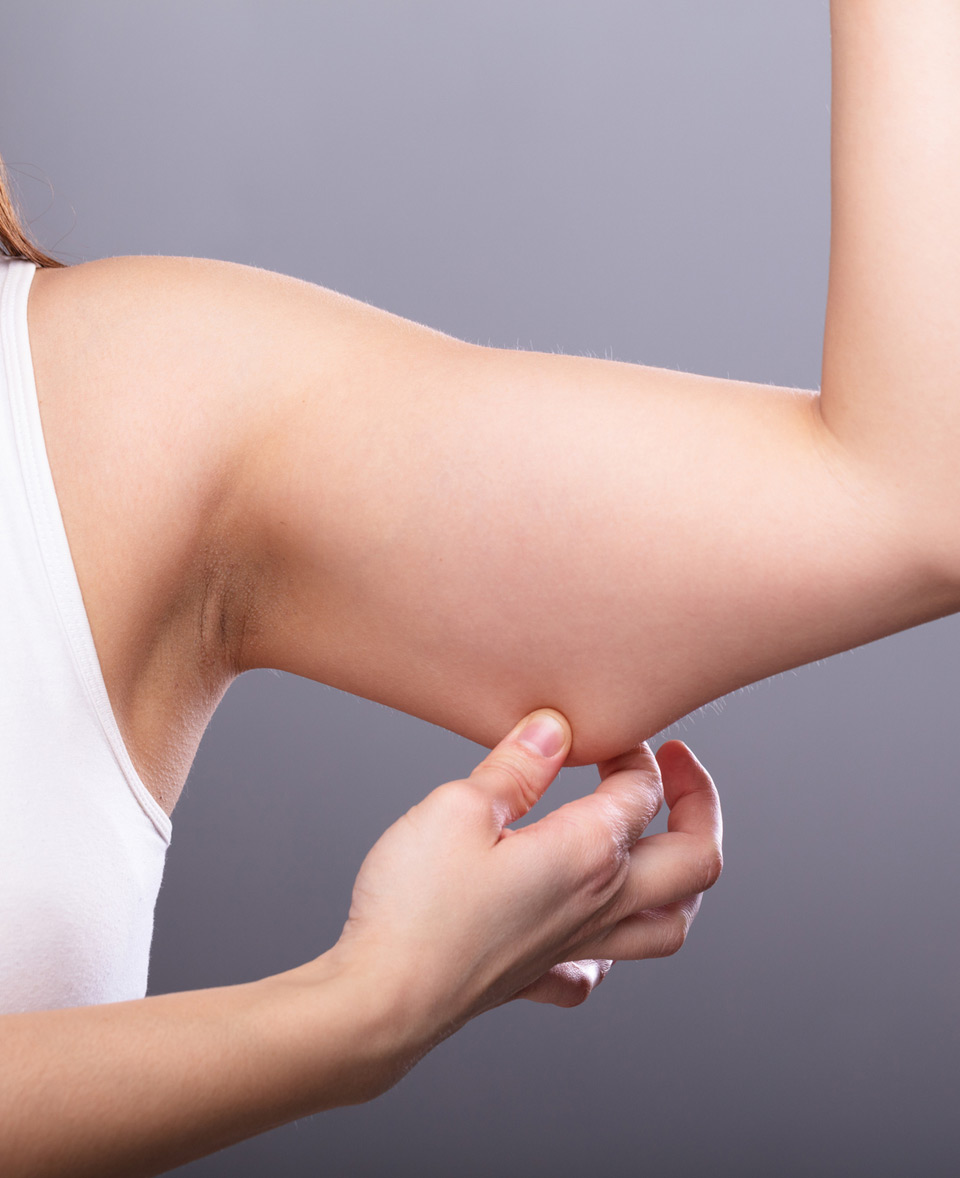 Close-up-of-a-woman-holding-arm-with-excess-fat-and-needing-CoolSculpting