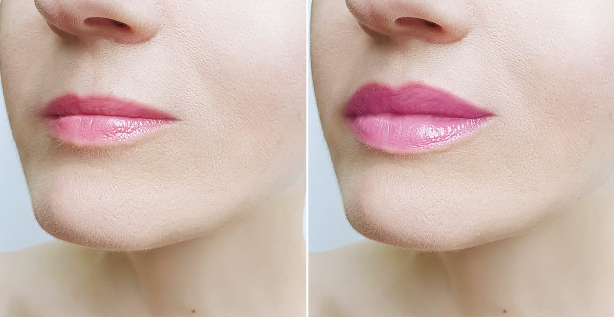 before-and-after-photos-of-lip-injections