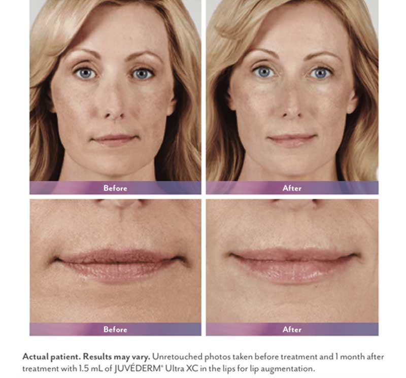 juvederm-ultra-before-after