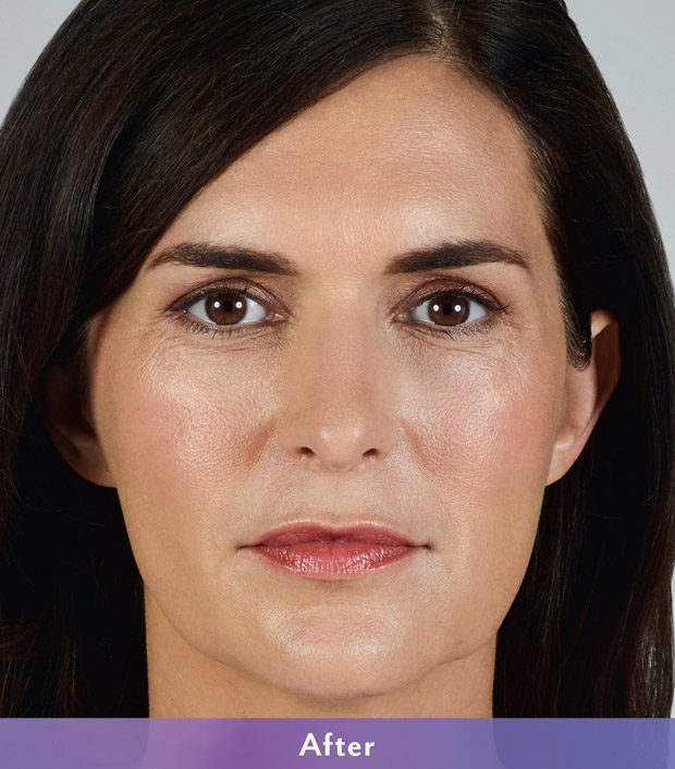 juvederm-vollure-after-catherine