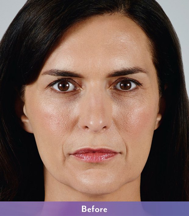 juvederm-vollure-before-catherine