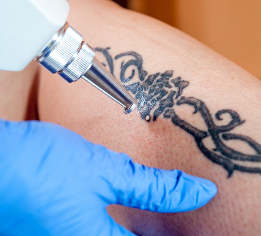 skin-care-specialist-providing-laser-tattoo-removal