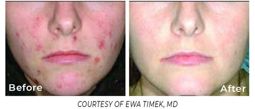 skin-resurfacing-before-and-after-with-spectrum