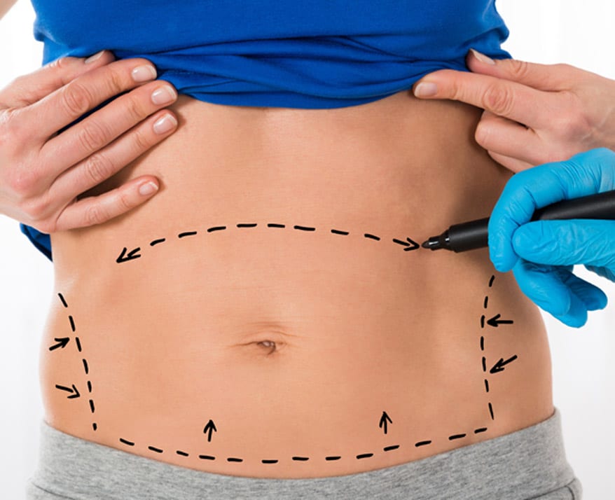 surgeon-drawing-correction-lines-on-patients-abdomen-before-tummy-tuck-procedure