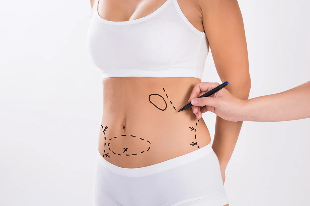 surgeon-making-marks-on-a-females-abdomen-before-liposuction-and-tummy-tuck-surgery