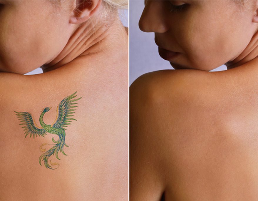 woman-before-and-after-laser-tattoo-removal