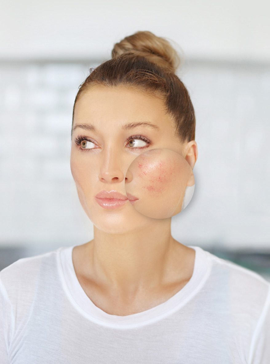 woman-with-acne-scars-needing-laser-skin-resurfacing-treatment