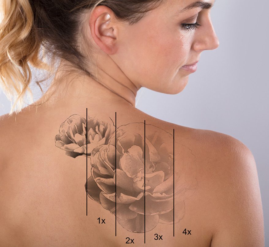 woman-with-different-stages-of-laser-tattoo-removal