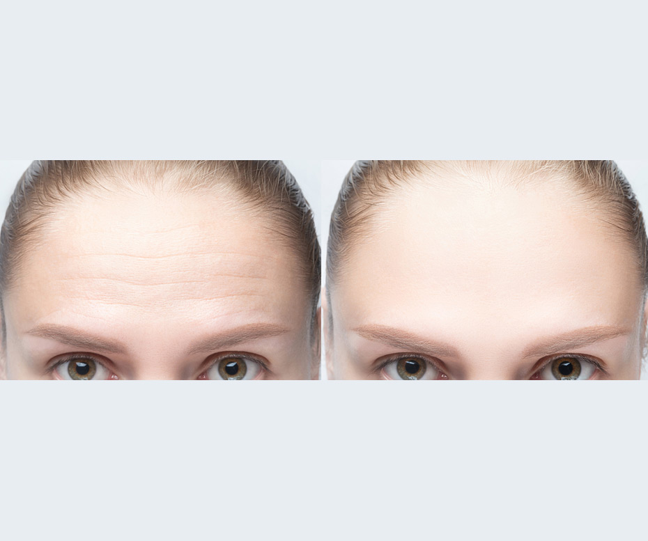 Forehead-wrinkles-before-and-after-injection