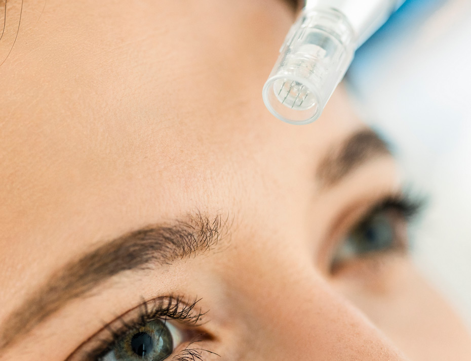 Microneedling-treatment-on-a-patient