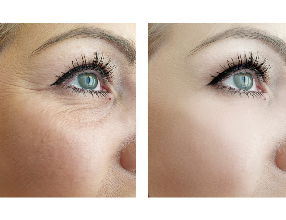 Woman's-eye-wrinkles-before-and-after-procedure