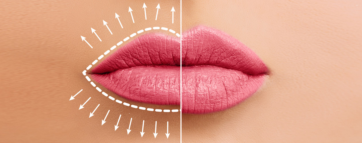 concept-of-lips-swelling-or-fillers