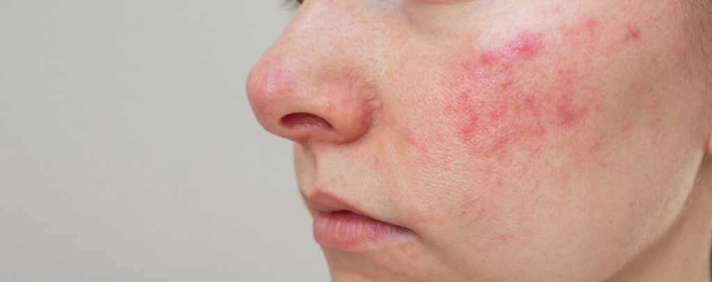 female-with-rosacea